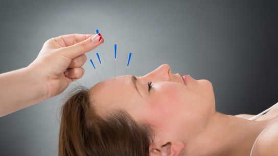 hand of acupuncturist putting needles into womans forehead