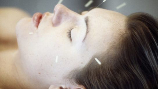 acupuncture