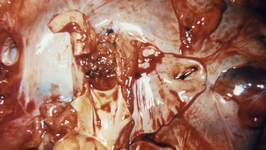 blockage of the right pulmonary artery in a case of bacterial endocarditis