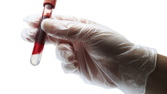 High Triglycerides Linked to Small Vessel Disease