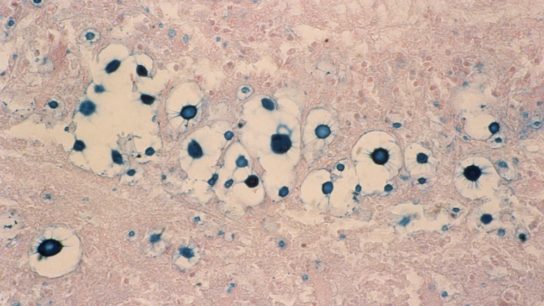 brain fungal infection