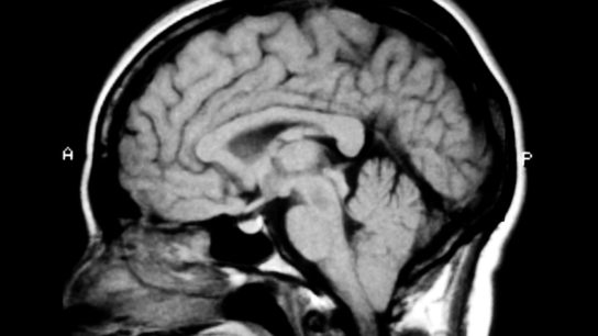 Myth 5: Chiari I Is a Feature of SIH