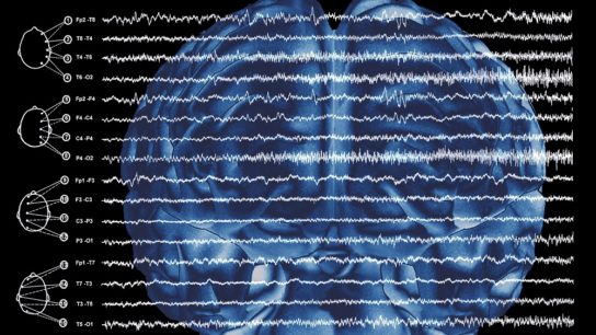 EEG focal epilepsy