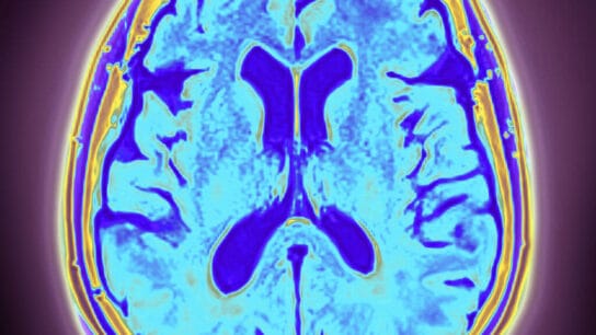 dementia with lewy bodies