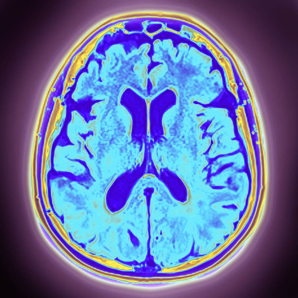 dementia with lewy bodies
