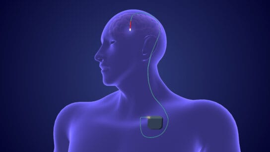 Deep brain stimulation (DBS)