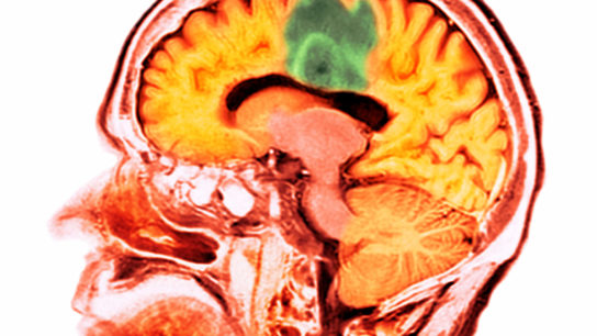 Image of glioblastoma.
