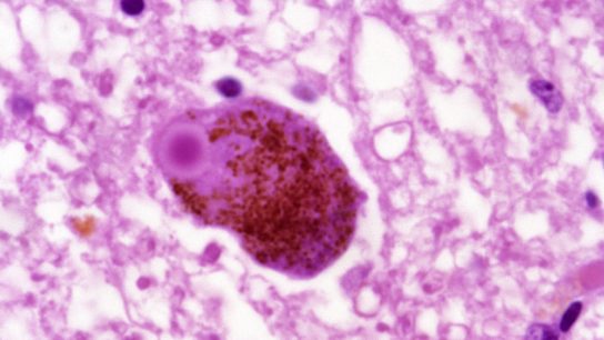 lewy body parkinson's