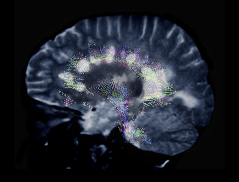 MRI of MS
