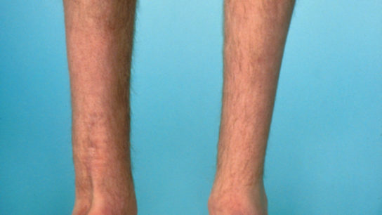 spinal muscular atrophy