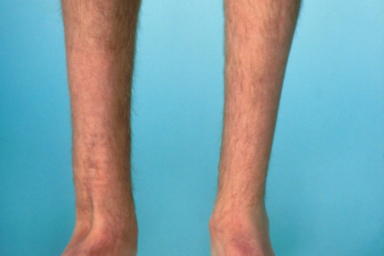 spinal muscular atrophy