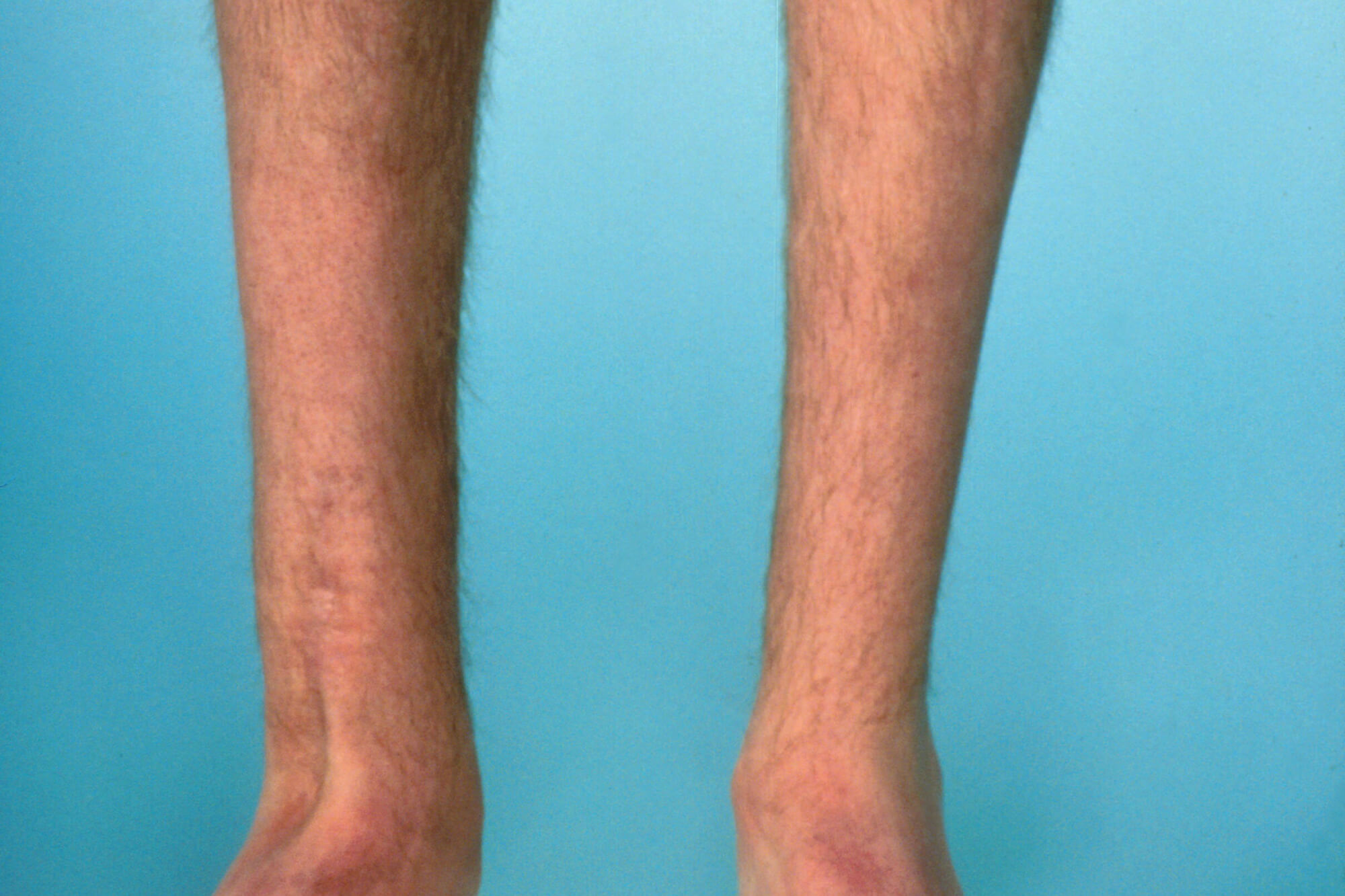 spinal muscular atrophy