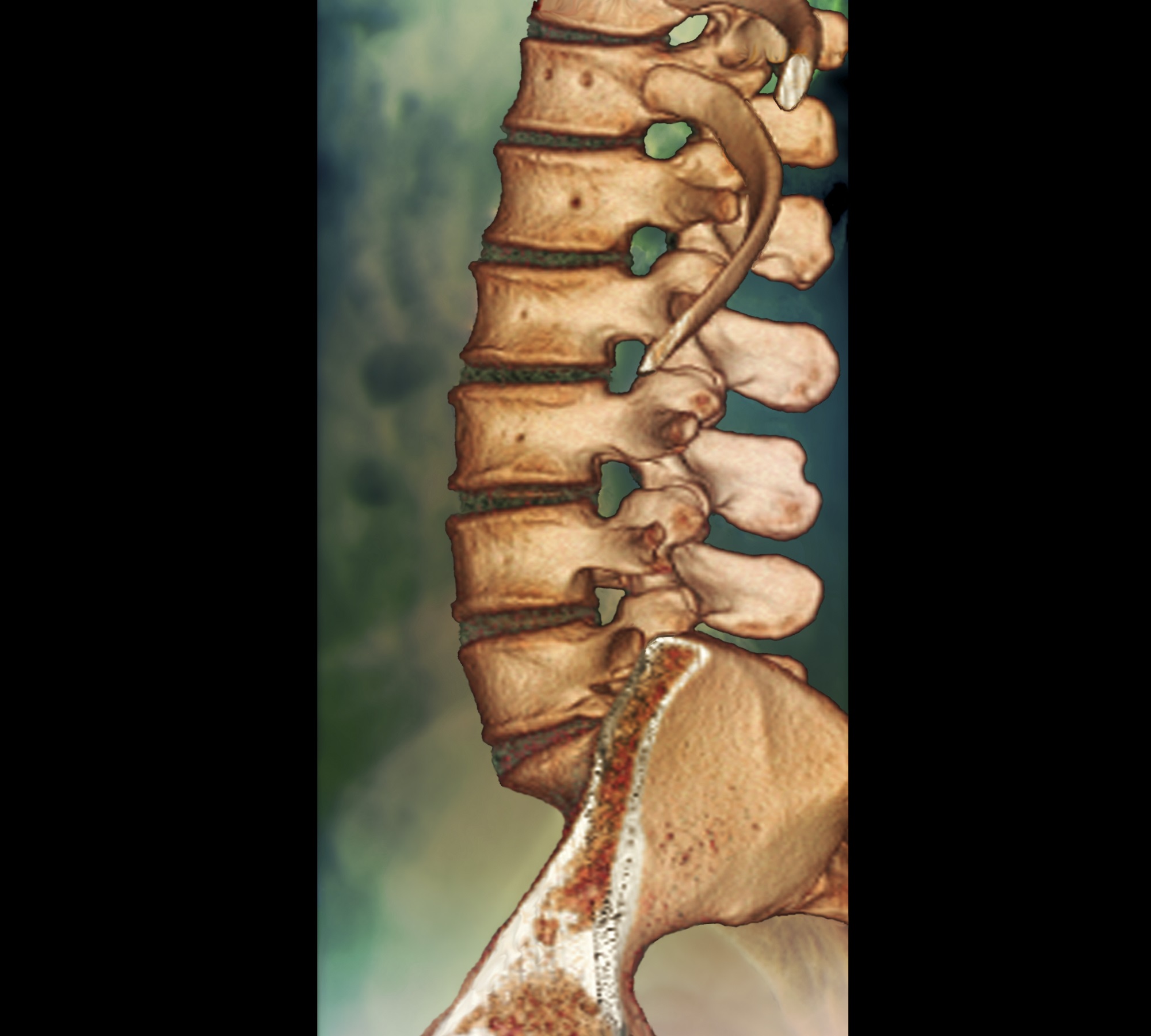 spinal CT scan