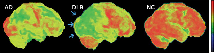 File:Surface FDG Alzheimer Disease and Dementia with Lewy Bodies.jpg