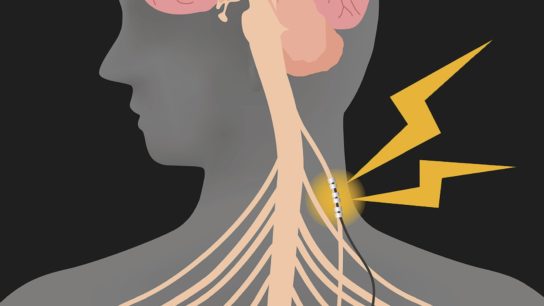 vagus nerve stimulation