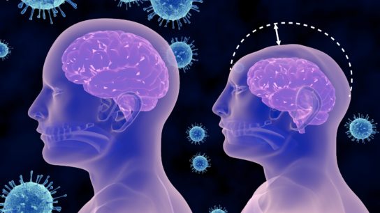 zika virus and microcephaly