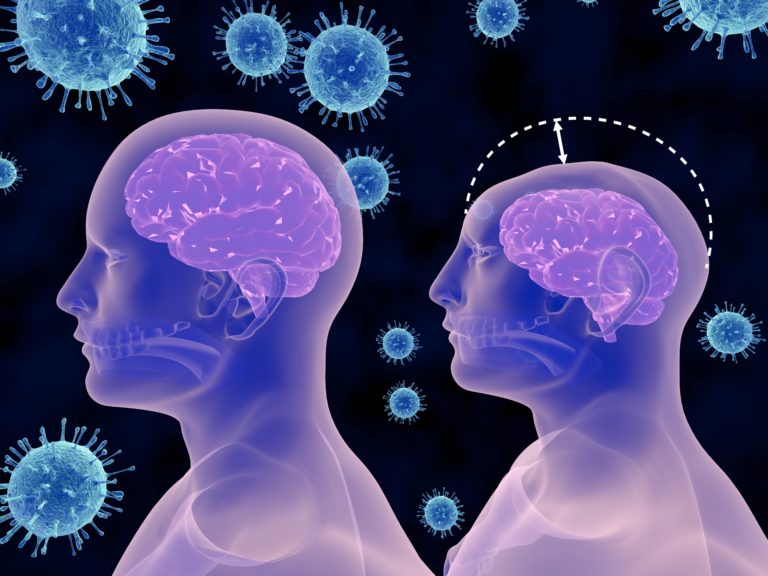 zika virus and microcephaly