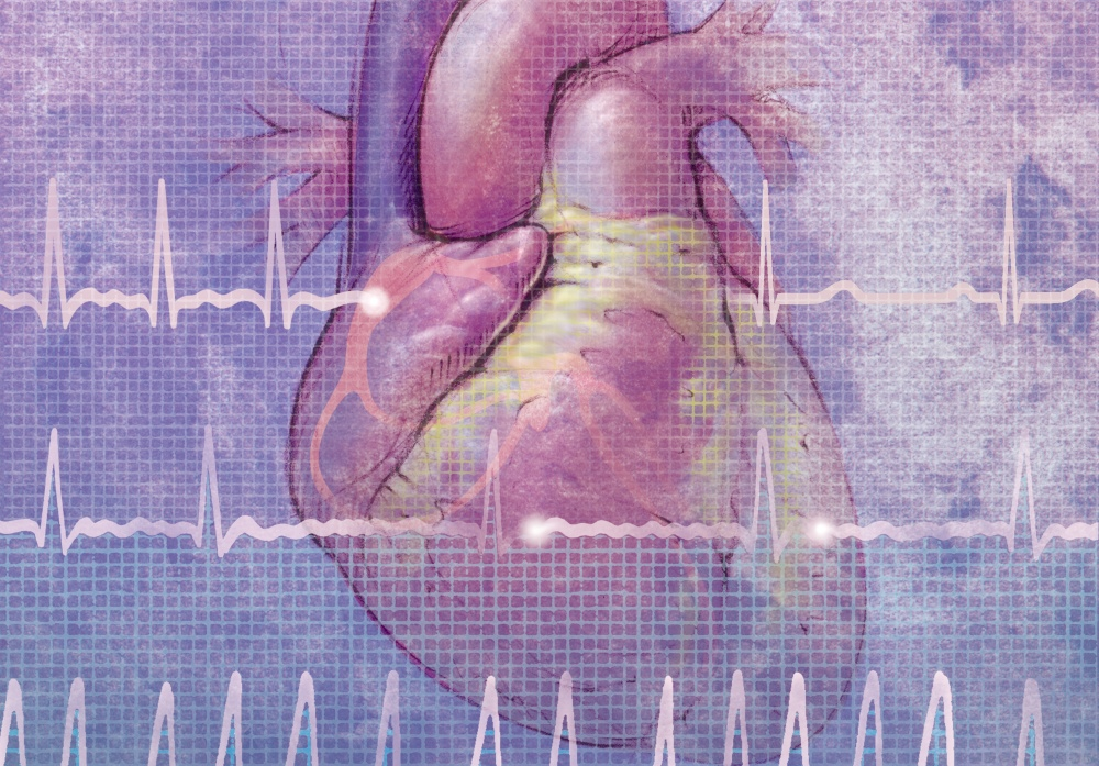 AtrialFibrillationWithHeart_MI_01AFTFMK_cropped