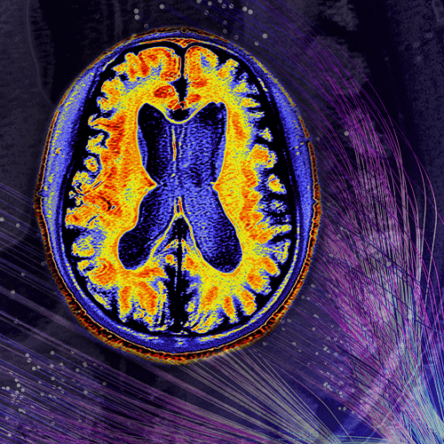 Anti-Amyloid Treatment for MCI and Dementia