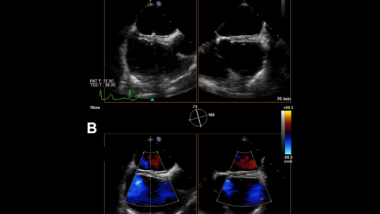 Foramen-ovale-occluder