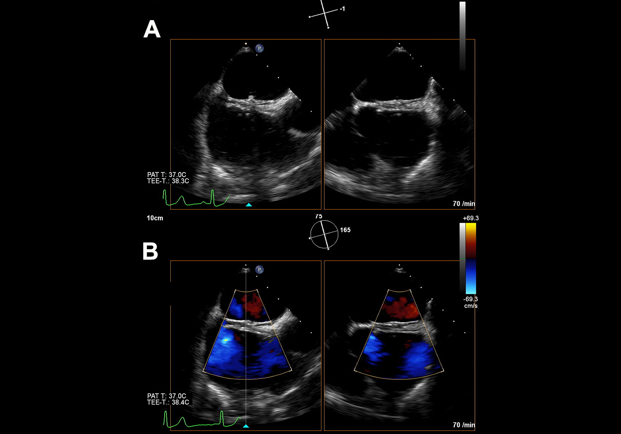Foramen-ovale-occluder