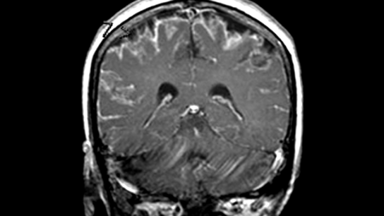 MRI of meningitis