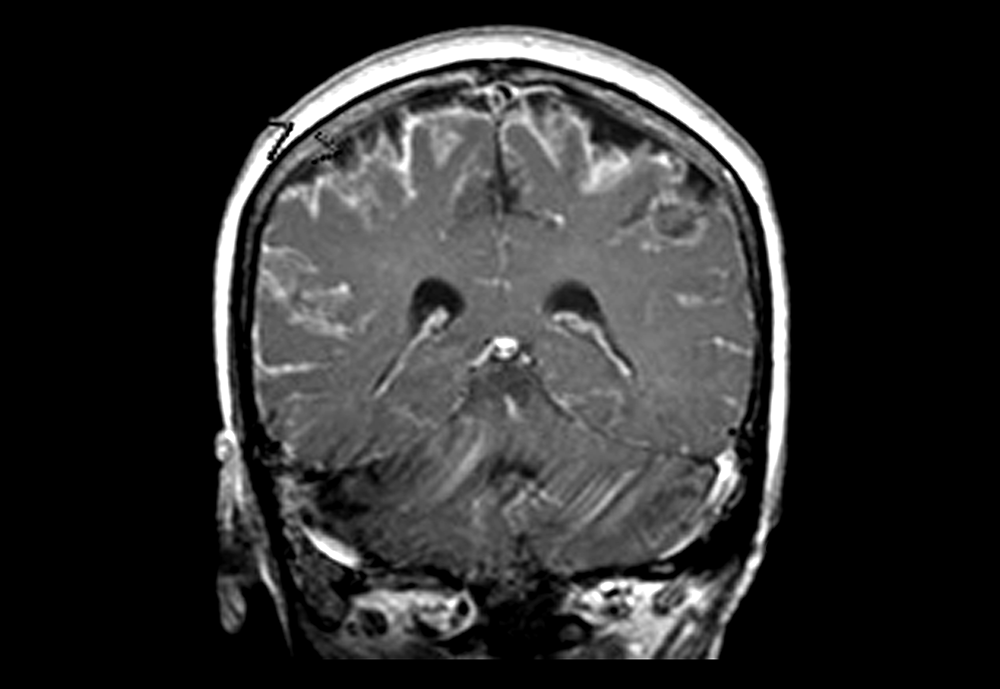 MRI of meningitis